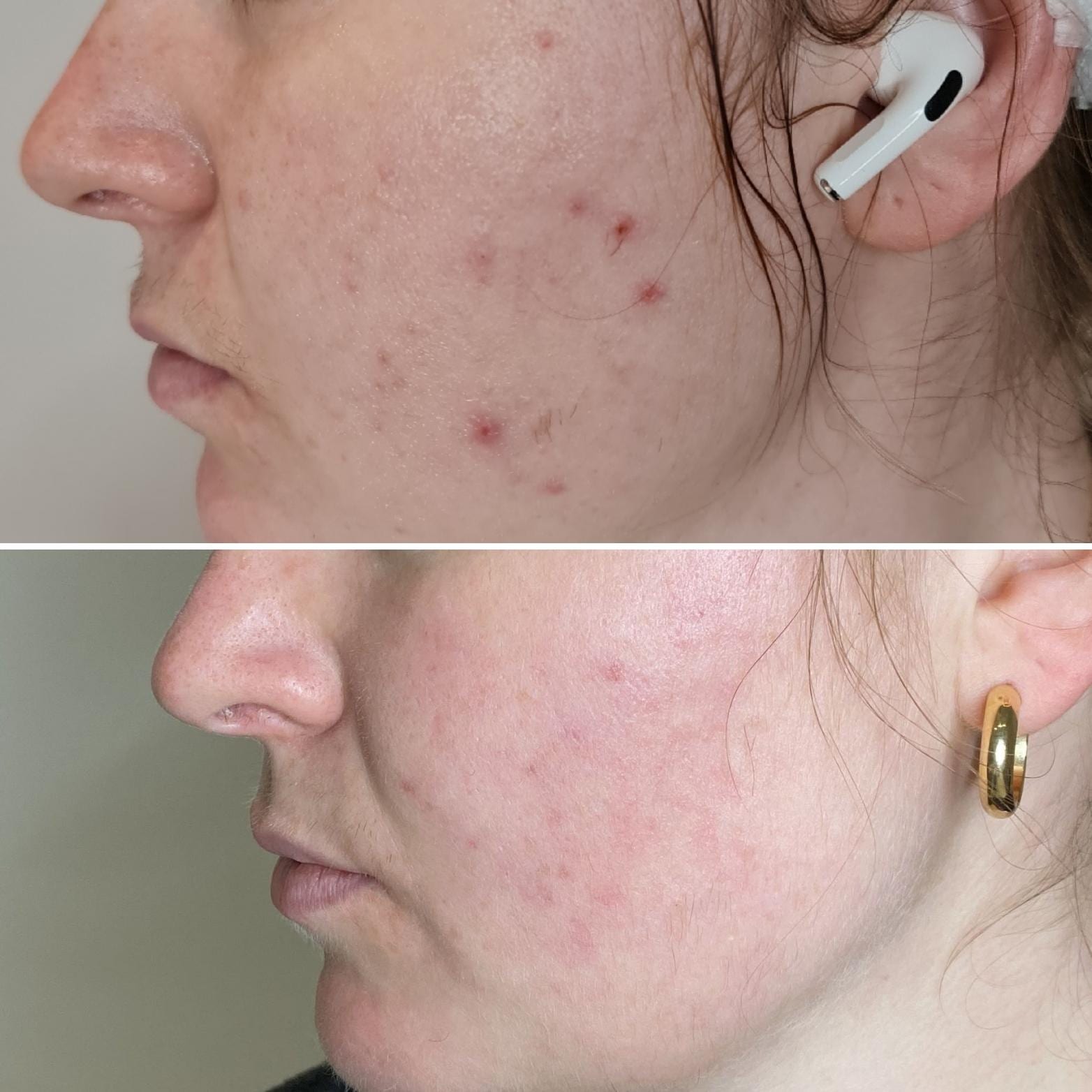 Acne Treatment | A close-up  image of a person's cheek before and after acne treatment.