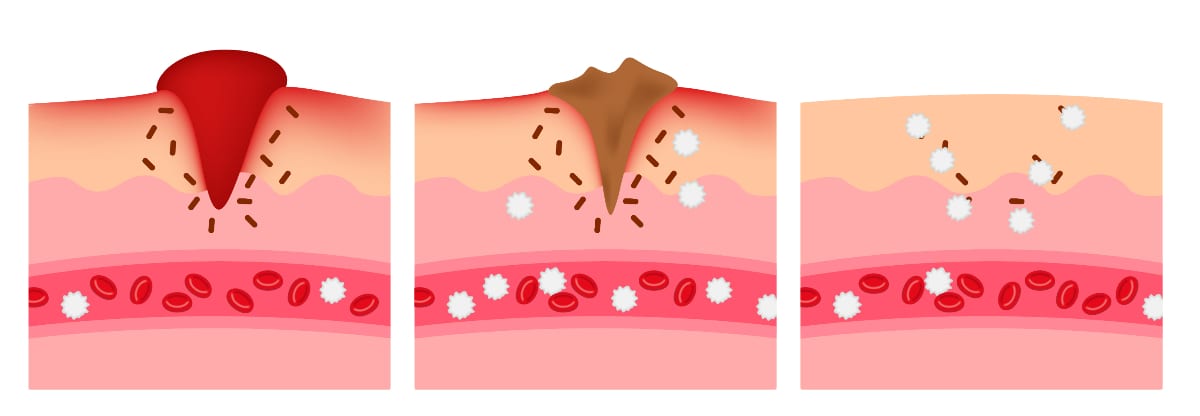 Exosome | infographic of how the wound heal by platelet and white blood cell vector