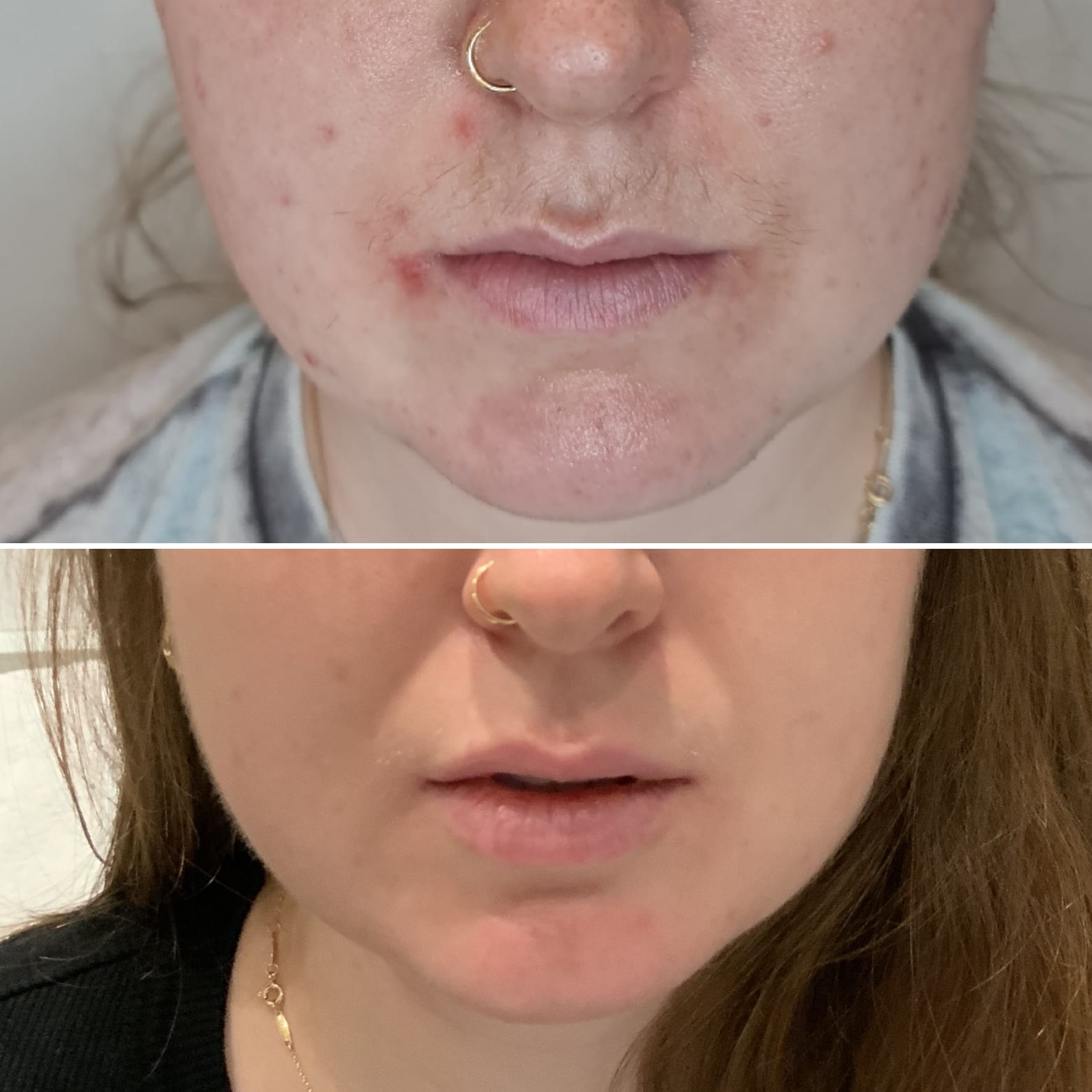 Acne Treatment | A close-up  image of a person's lower face before and after acne treatment.