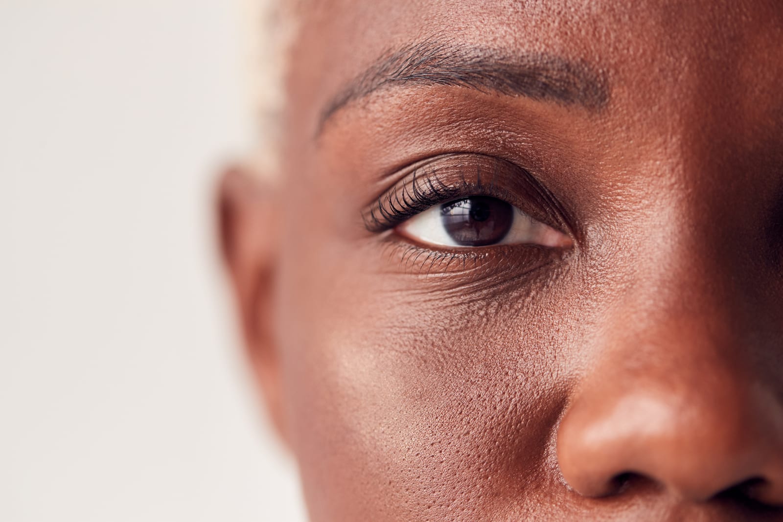 Under-eye fillers | A close-up of a female eye
