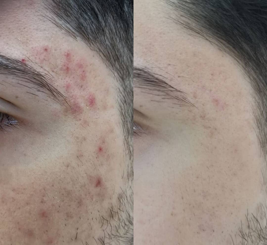 Acne Treatment | A close-up  image of a person's temple area before and after acne treatment.