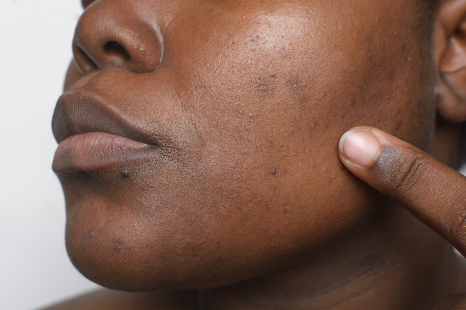 An example of a case of mild acne