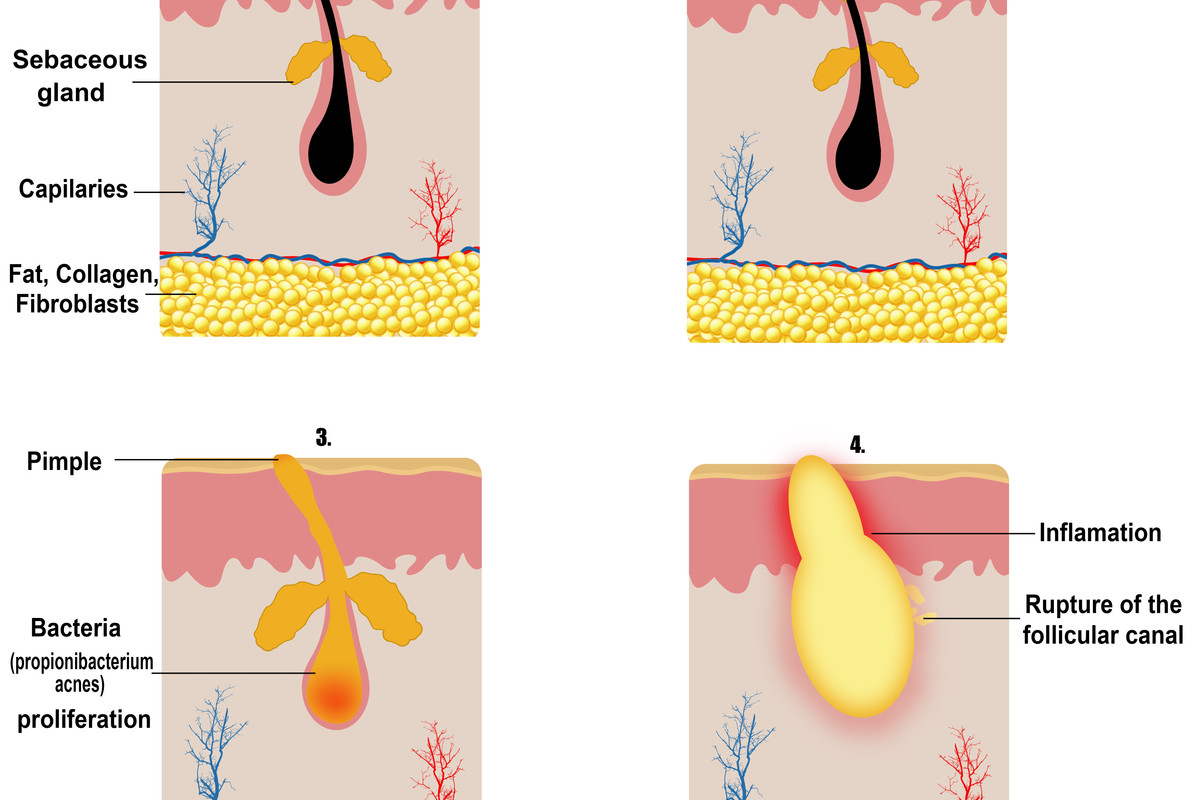 Acne: What, Why, How