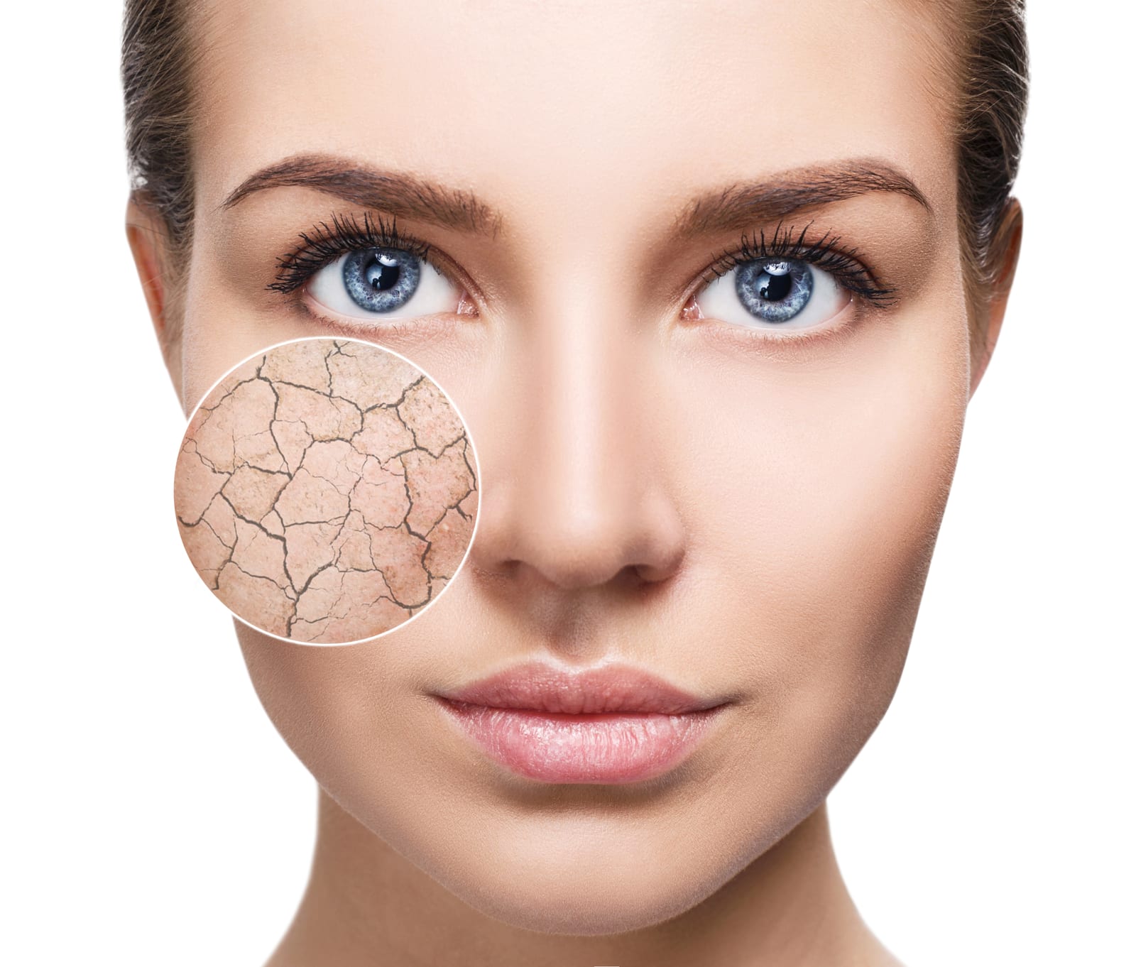 HydraFacial | A graphic representation of dehydrated skin