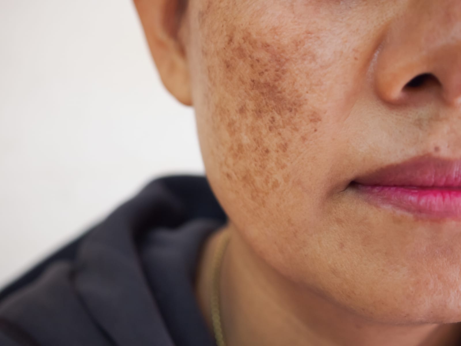 Melasma | A close-up of a person's face with melasma on their cheek