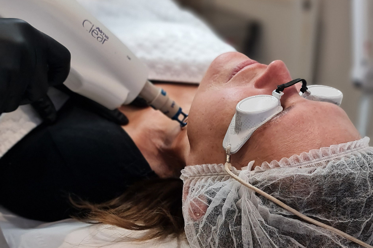 Laser Resurfacing Before & After: A Client’s Story