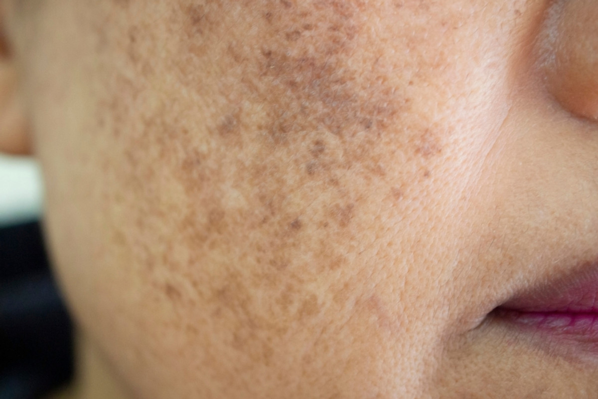Melasma: What It Is, Why It Happens and How to Manage It