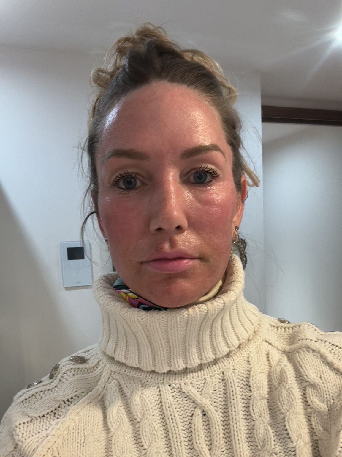 Laser Resurfacing | A photo of a client's skin on the day of resurfacing