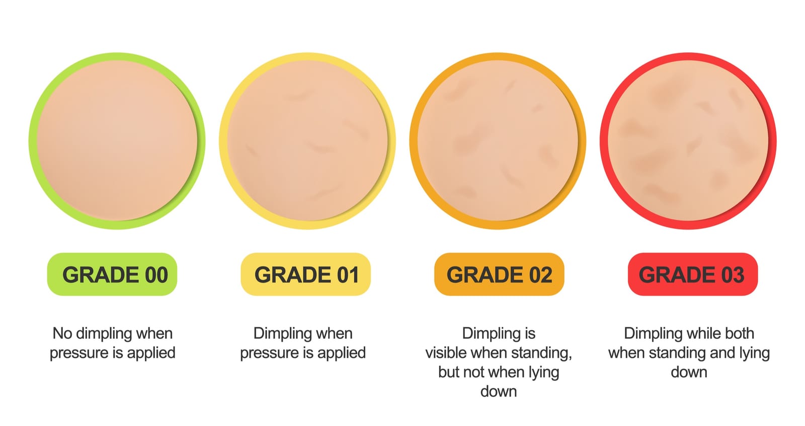 Cellulite | A cartoon illustration of the cellulite grading scale