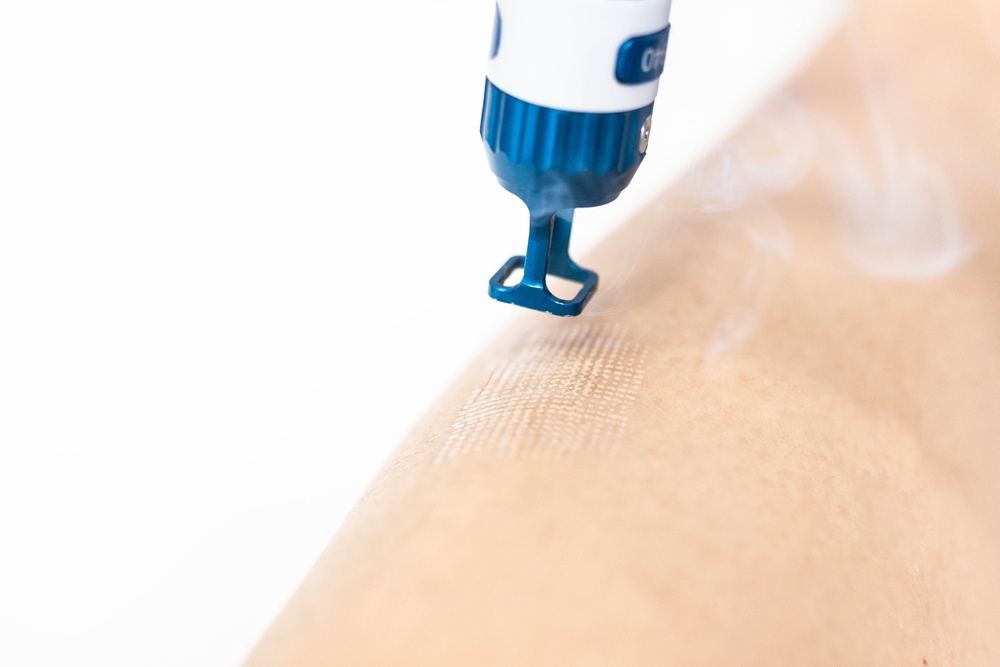 IPixel Laser Resurfacing