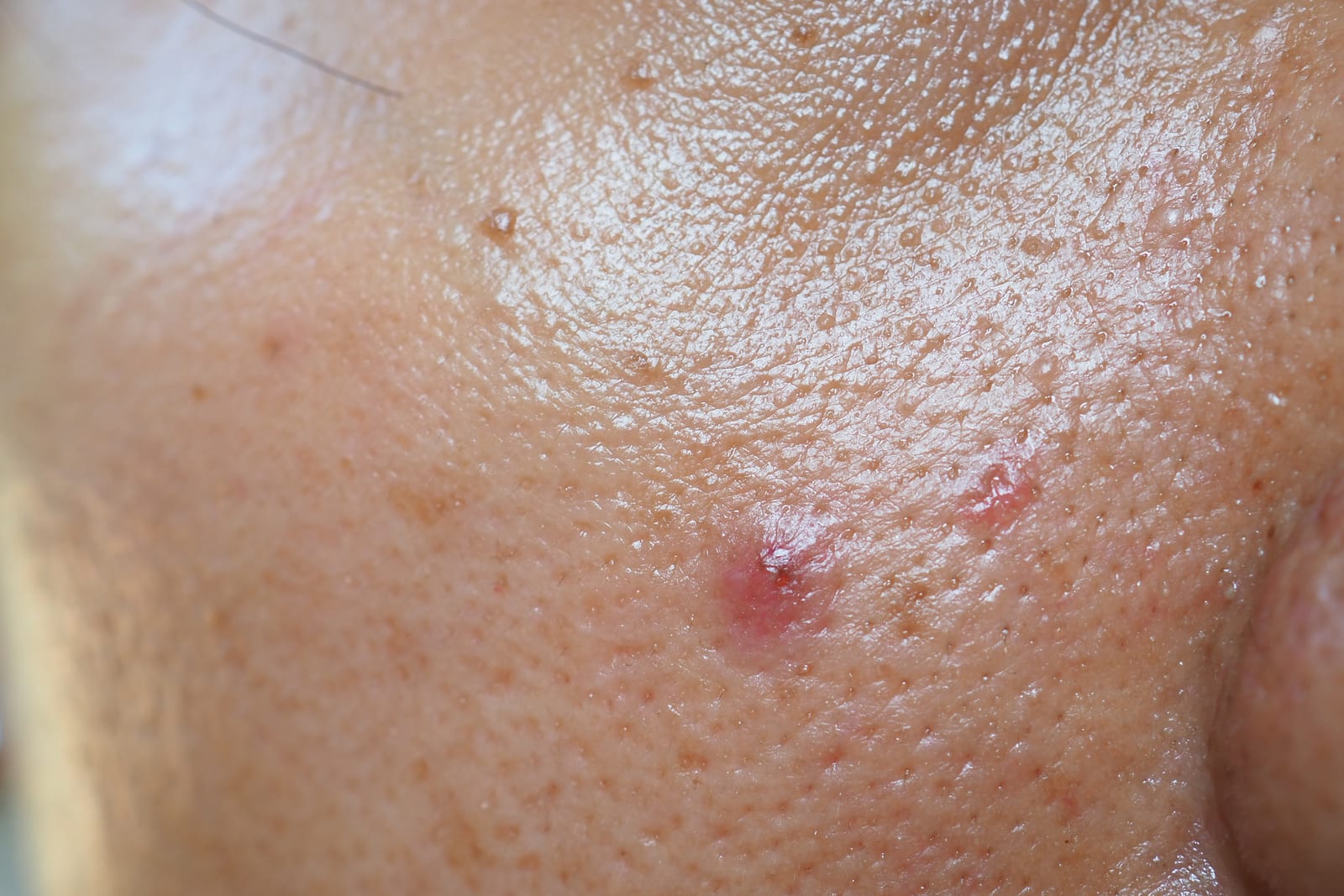 Pores | A photo of an individual with oily skin, close up photo of the cheek.