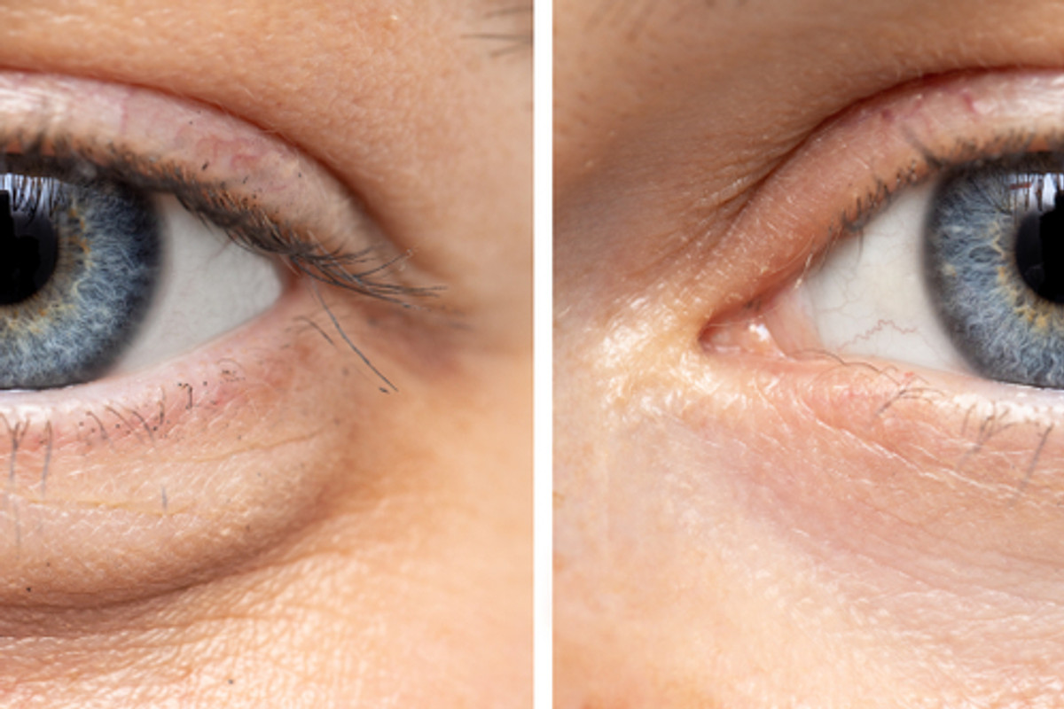 How to Reduce Eye Bags