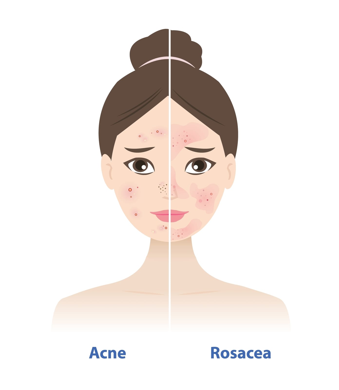 Rosacea VS Acne | An illustration highlighting the differences between rosacea and acne. While both may appear as red bumps.  Rosacea is not caused by clogged pores and no blackheads or whiteheads will show up.