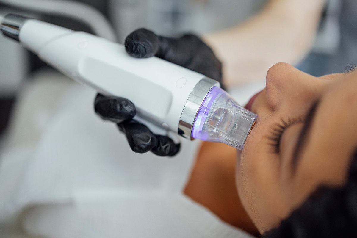 The Benefits of RF Microneedling