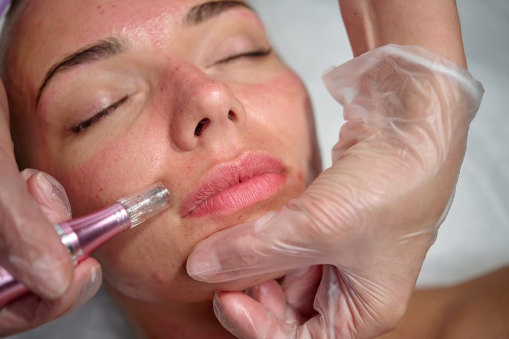 RF Microneedling | A woman having microneedling treatment on the face.