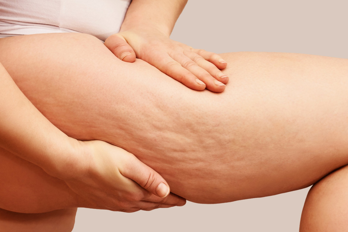 Cellulite: What, Why, How?