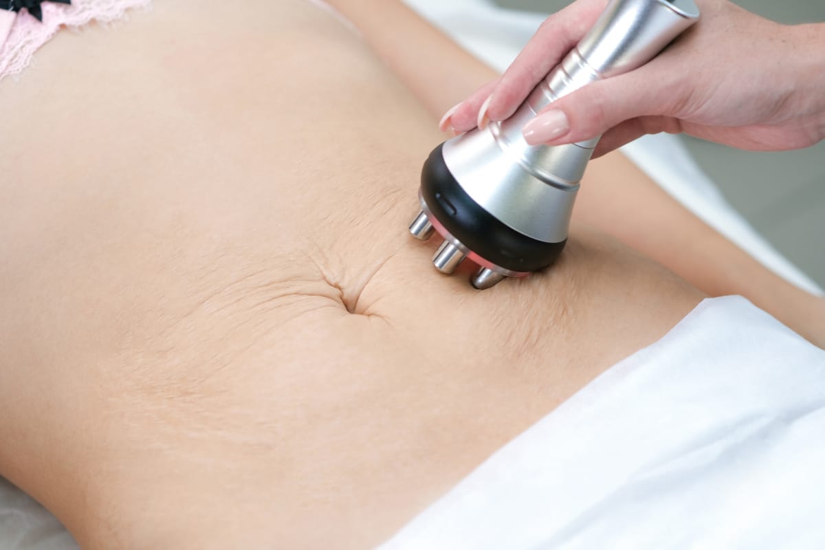 RF Microneedling | A woman having radiofrequency treatment on the tummy for stretch marks.