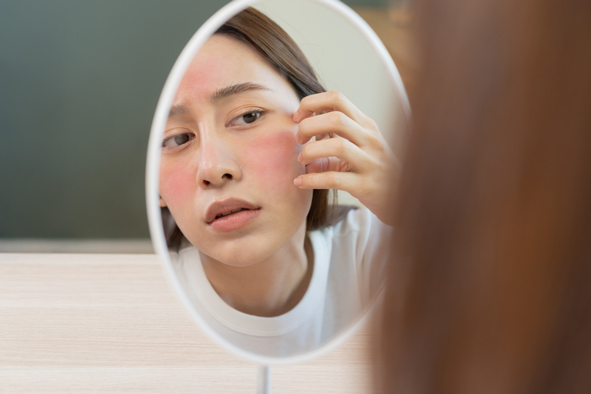 Understanding Rosacea: Why It Happens and How to Manage It