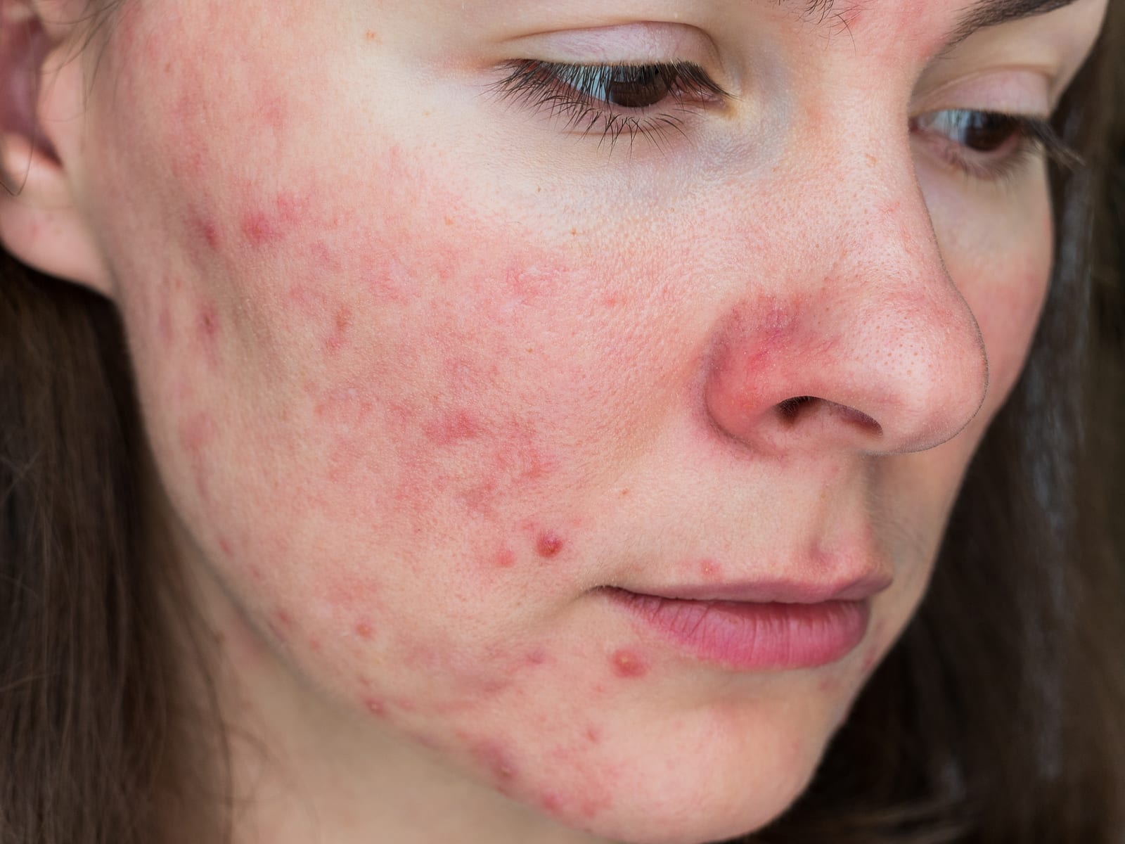 Rosacea | A girl with inflammatory rosacea showing red bumps and pus-filled spots.