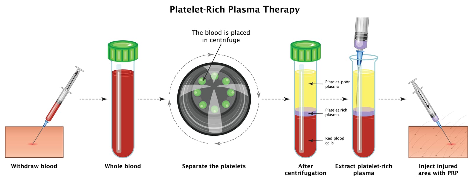 PRP treatment | An image of Platelet-Rich Plasma Therapy treatment process.