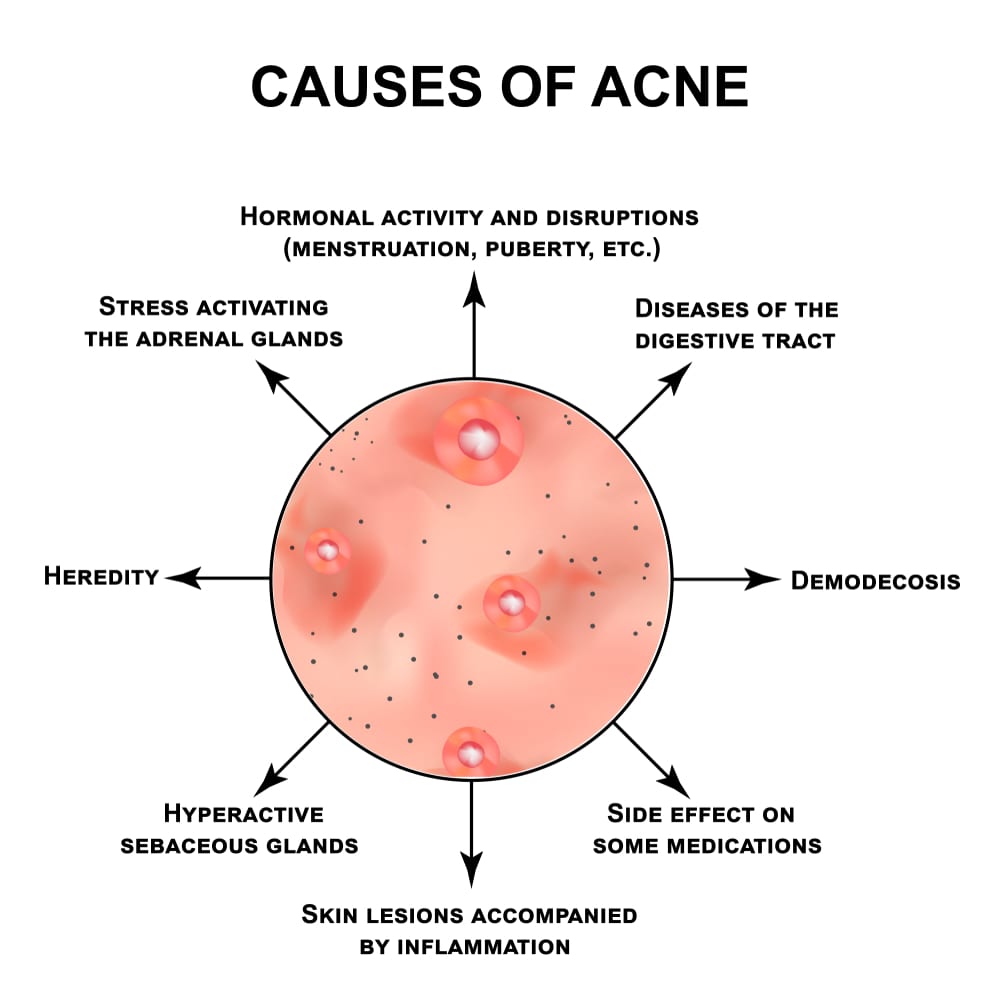 Acne Cure | An illustration of the many causes of acne