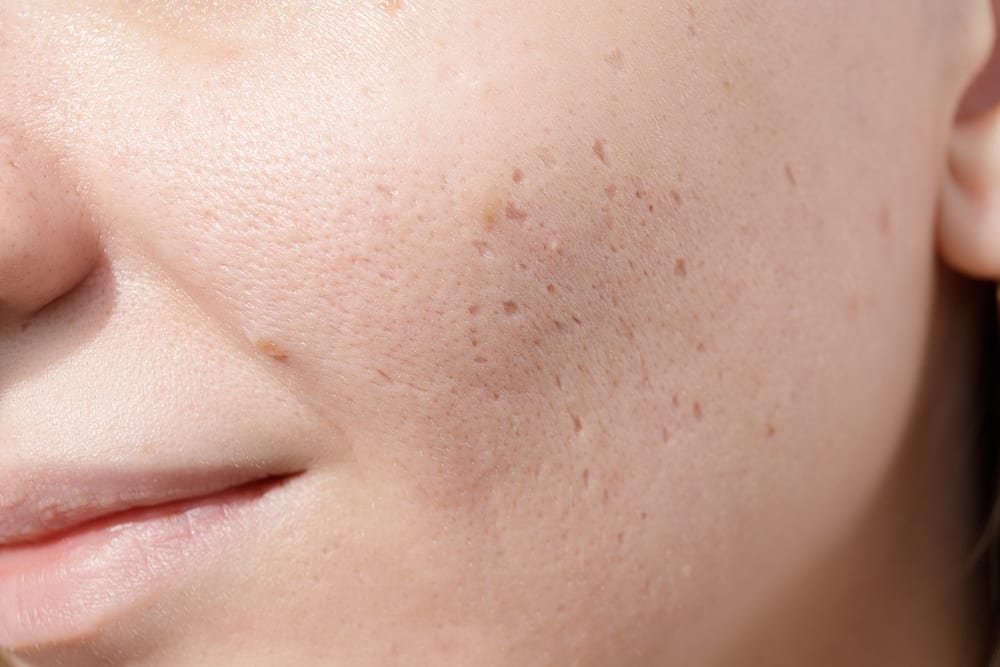 RF Microneedling | Young woman suffering from problem skin and acne closeup, icepick scars acne on cheek