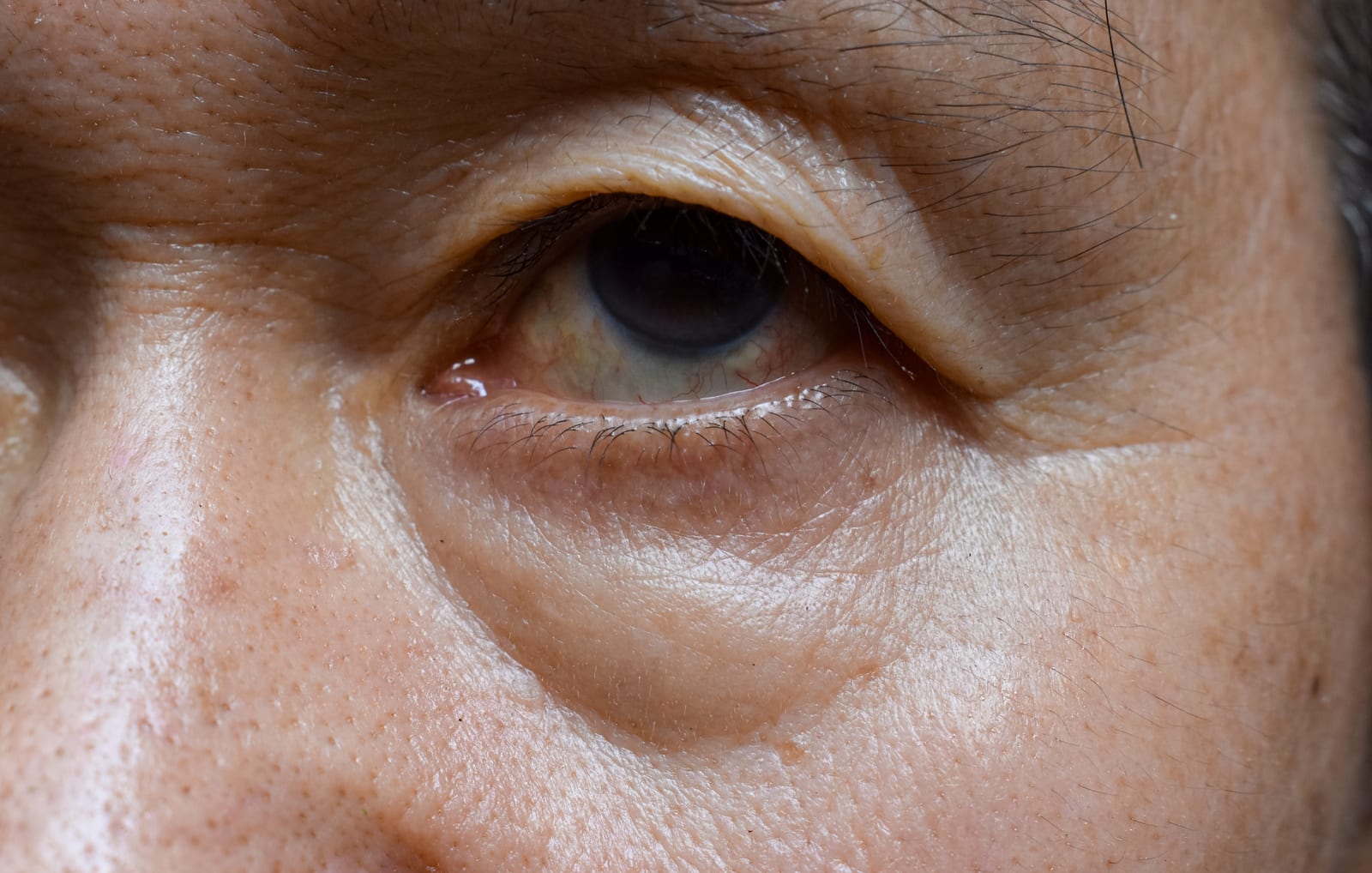 Blepharoplasty | A close-up of an eye with an excess fat pad under the eye.